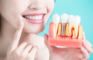 know about dental implants