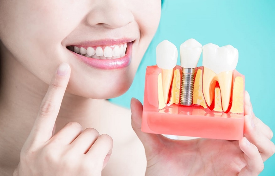 know about dental implants