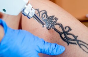 Tattoo Removal Specialist