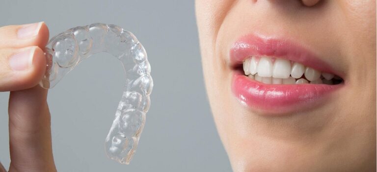 Braces or aligners