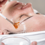 Chemical Peels in Twin Falls