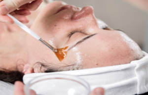 Chemical Peels in Twin Falls